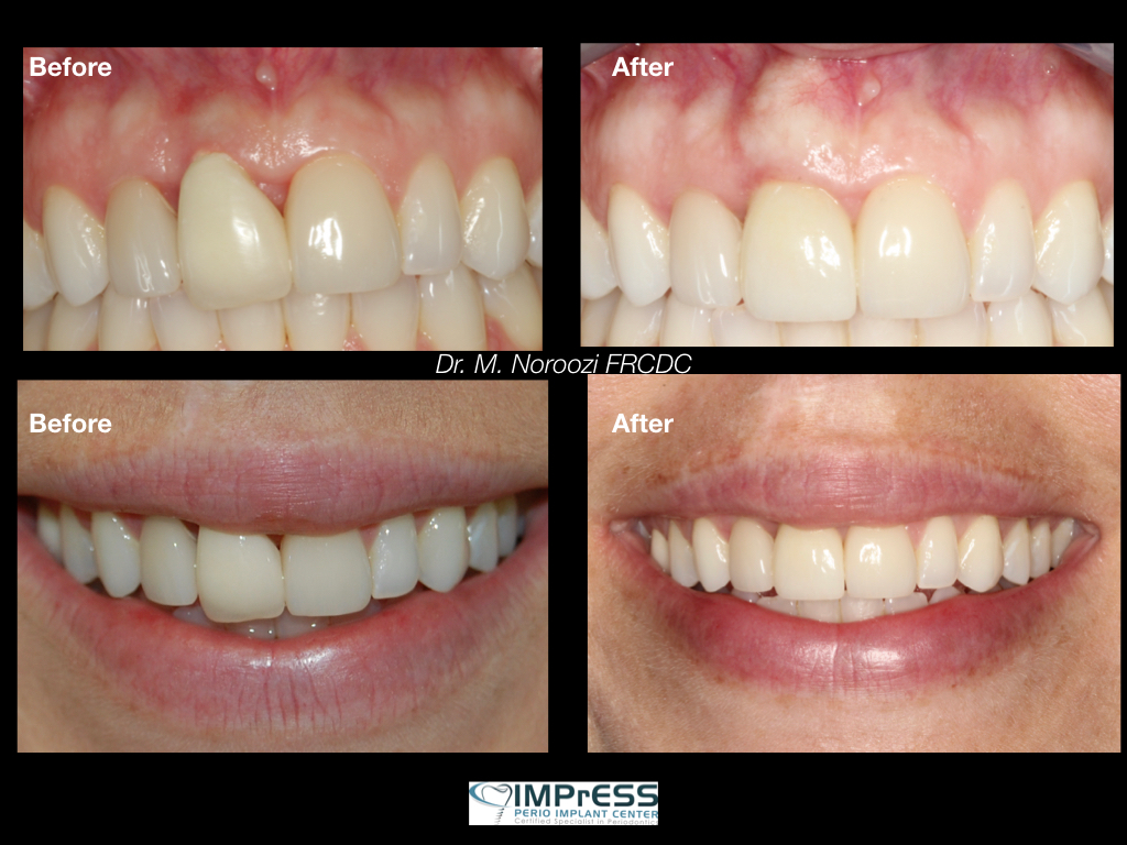 Explant / Dental Implant Removal - Leading Implant Centers